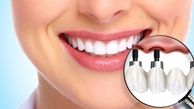 ایمپلنت دندان در بیماران دیابتی: بررسی شرایط، ریسک‌ها و توصیه‌های تخصصی برای موفقیت