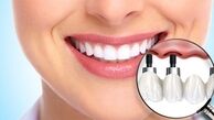 ایمپلنت دندان در بیماران دیابتی: بررسی شرایط، ریسک‌ها و توصیه‌های تخصصی برای موفقیت