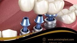 راهنمای جامع کاشت دندان؛ چطور بهترین خدمات ایمپلنت را در ارومیه تجربه کنیم؟