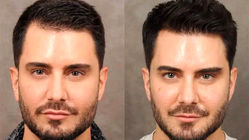 بهترین کلینیک کاشت مو در تهران؛ معیارهای انتخاب مرکز تخصصی چیست؟