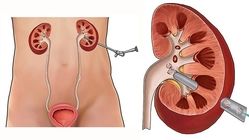 بهترین دکترهای سنگ کلیه در مشهد