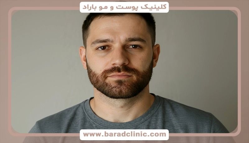راز جذابیت مردانه بهترین روش کاشت ریش طبیعی و دائمی که چهره‌تان را متحول می‌کند!