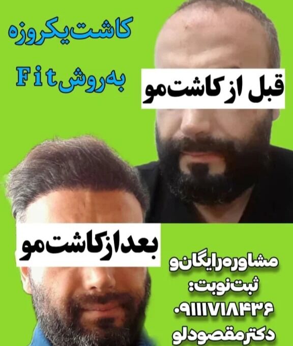 توصیه&zwnj;های دکتر مقصودلو برای حفظ تراکم مو بعد از کاشت